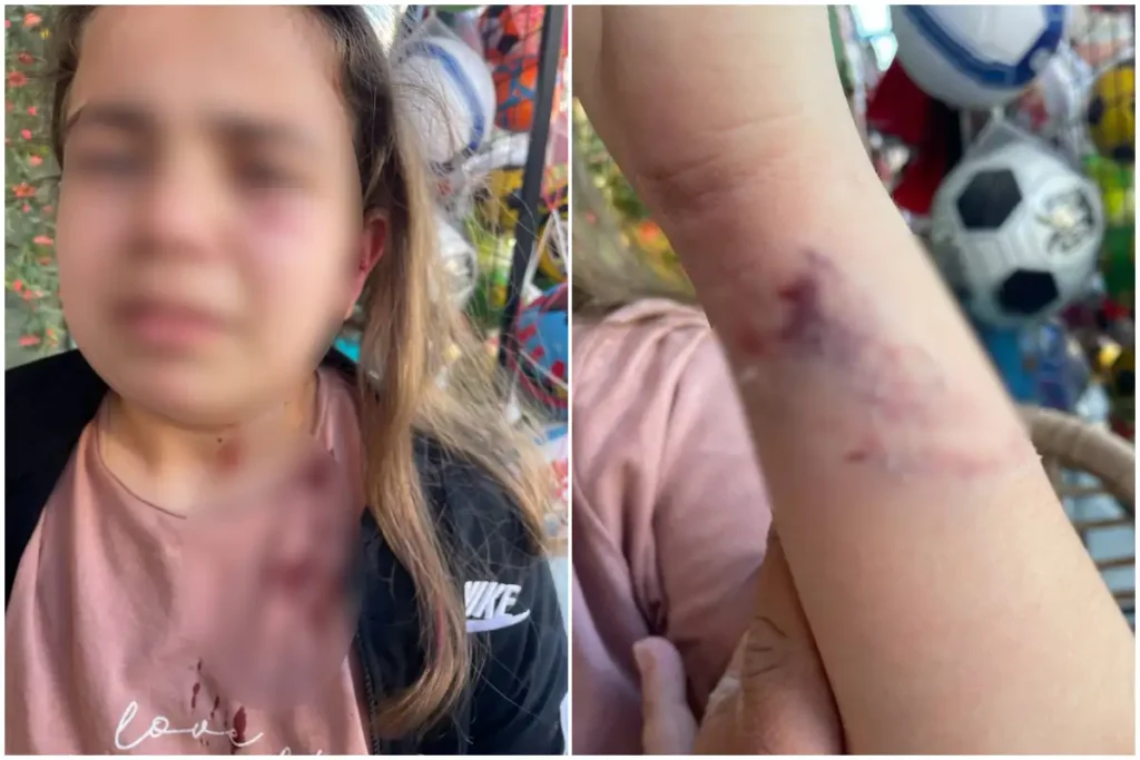 Πέλλα: Άγρια επίθεση από αδέσποτο σκυλί σε ανήλικη[Φωτογραφίες]