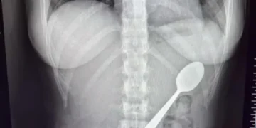 Απίστευτο ατύχημα στο Βέλγιο: Κατάπιε ολόκληρο κουτάλι εξαιτίας του σκύλου της!