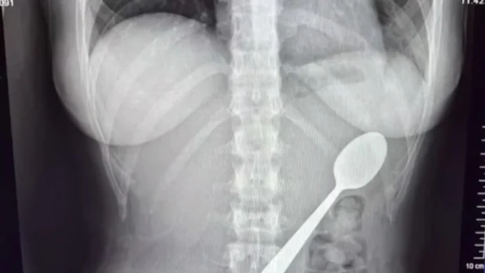 Απίστευτο ατύχημα στο Βέλγιο: Κατάπιε ολόκληρο κουτάλι εξαιτίας του σκύλου της!