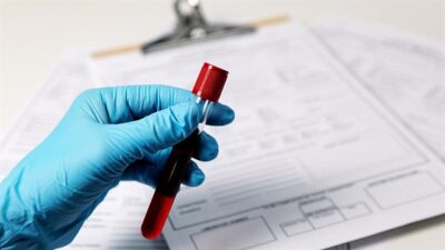 Εξετάσεις αίματος επιτρέπουν πλέον τη διάγνωση της νόσου Αλτσχάιμερ με ακρίβεια 90%